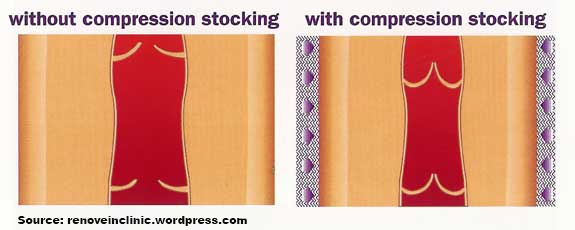 compression garments